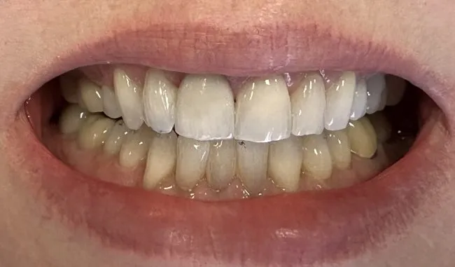 Smile Gallery Case 8